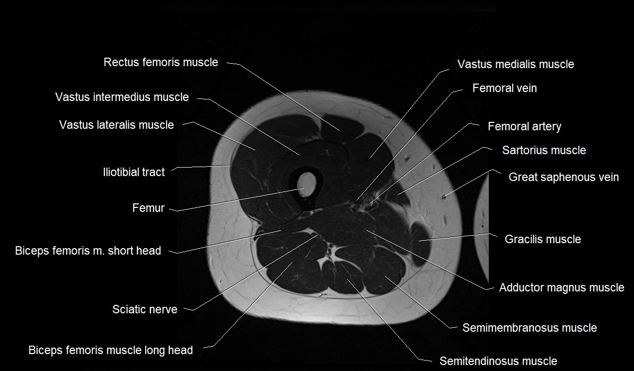 MRI thigh cross sectional anatomy image 35.webp